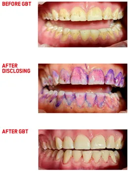 Before After