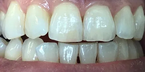 after whitening