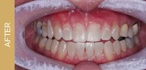 invisalign after