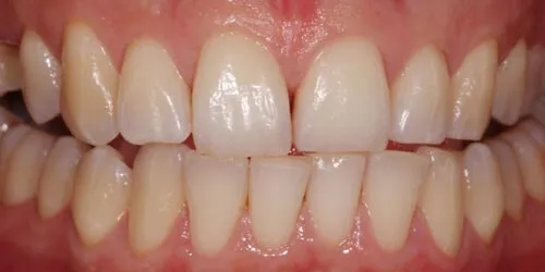 after whitening