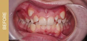 fixed braces before