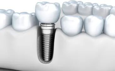 Dental Implants