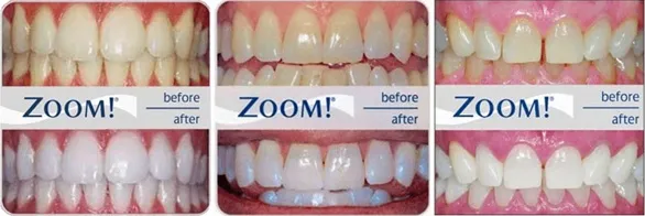 Before After