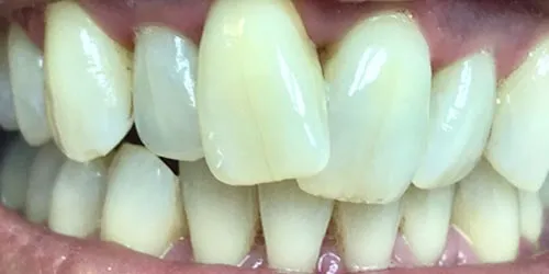 after whitening