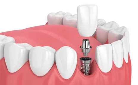 Dental Implants