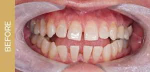 invisalign before