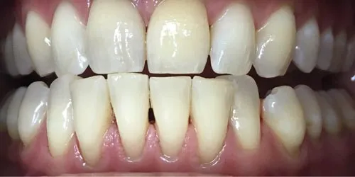 after whitening