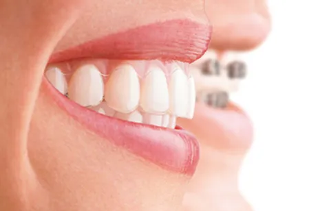 Invisalign-'invisible-braces