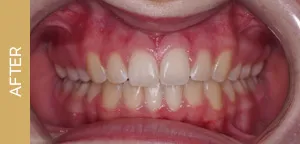 fixed braces after