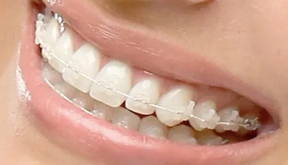 Tooth coloured fixed braces