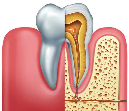 Root Canal Treatment