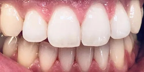 after whitening