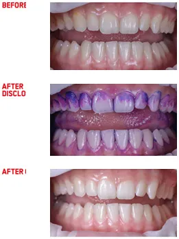 Before After