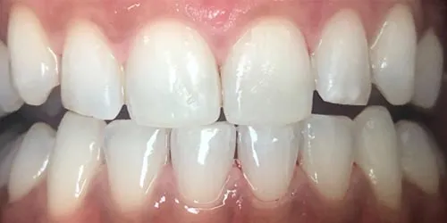 after whitening