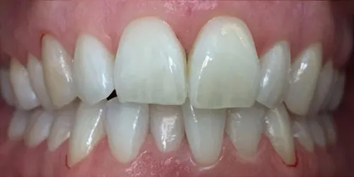 after whitening
